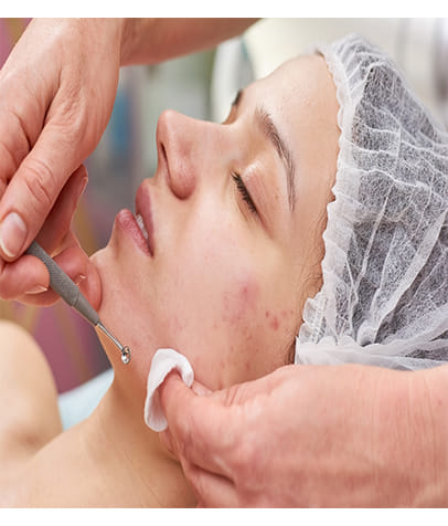 ance facial treatment